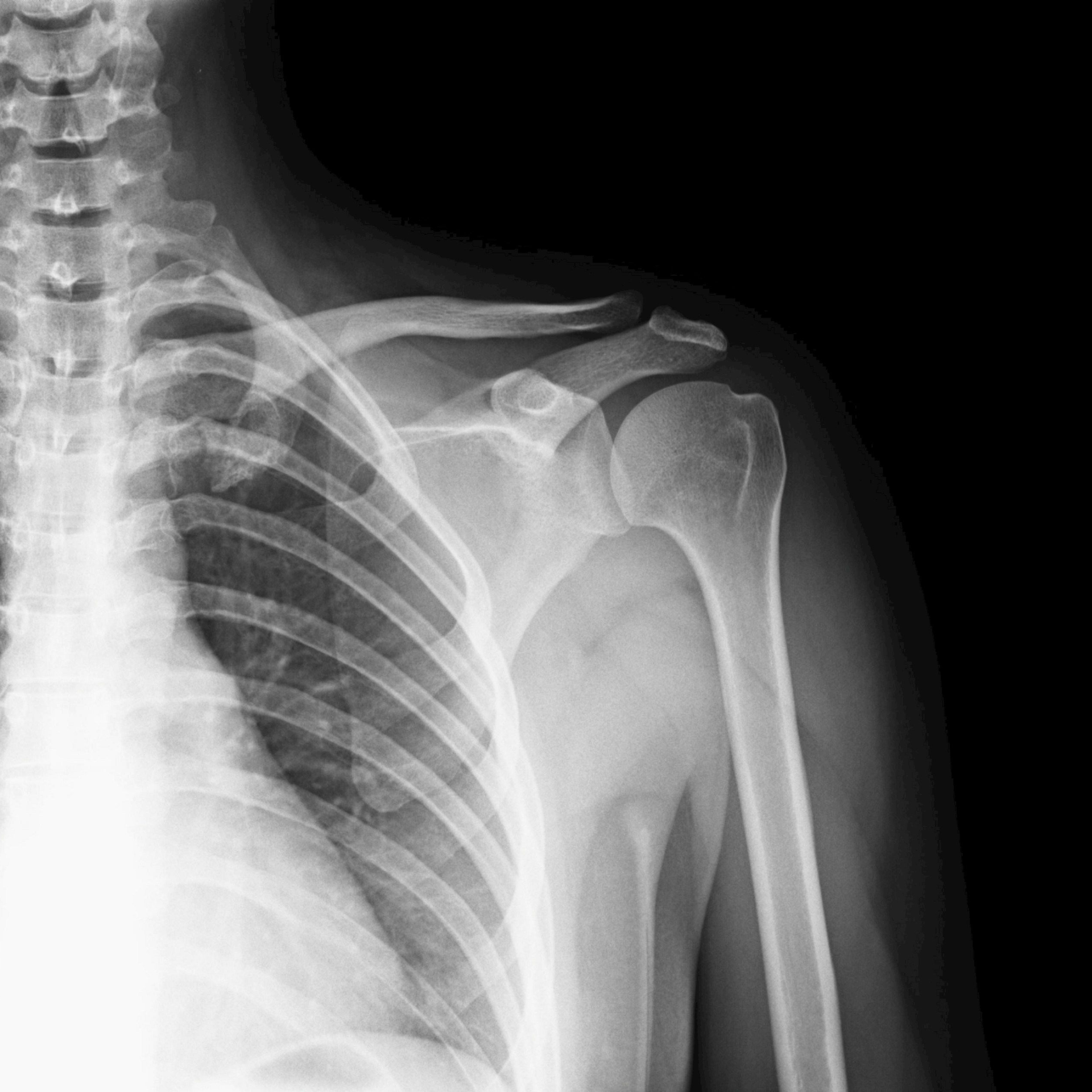 Schulterschmerzen verstehen: Das „Impingement"-Missverständnis